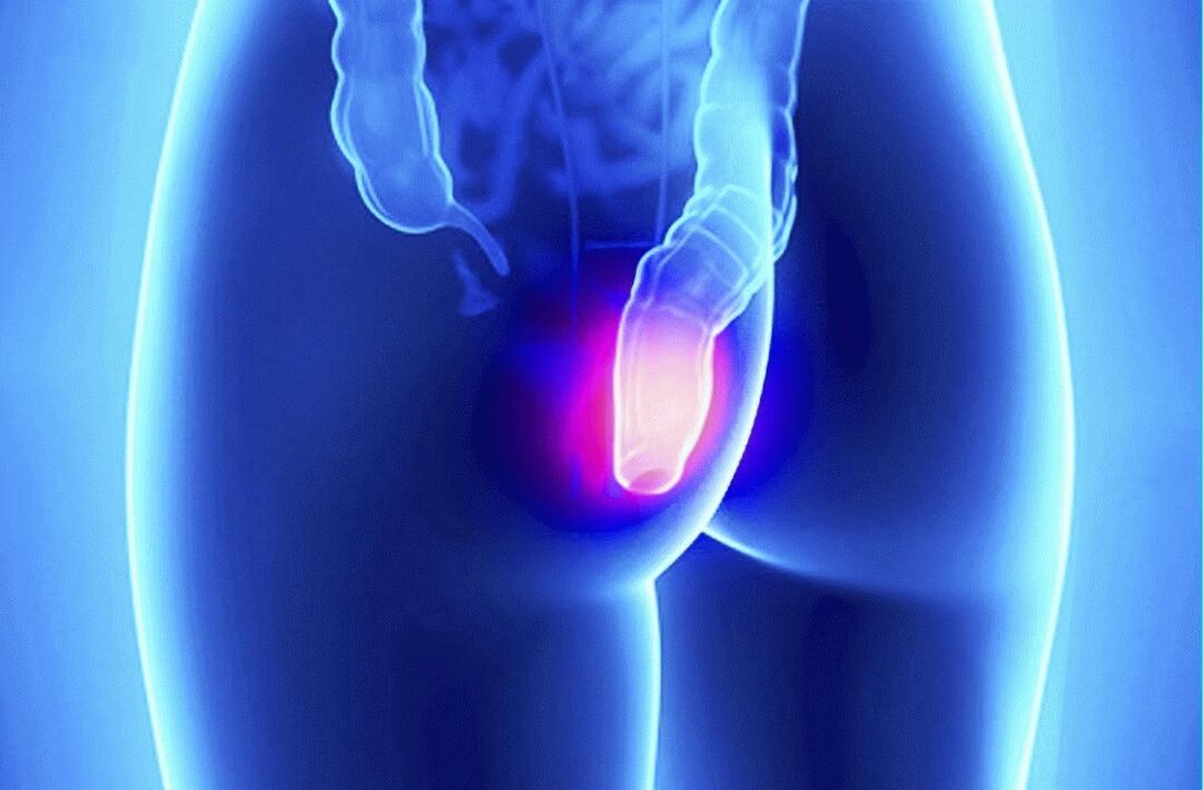 Gelarex kann sowohl äußerlich als auch rektal angewendet werden